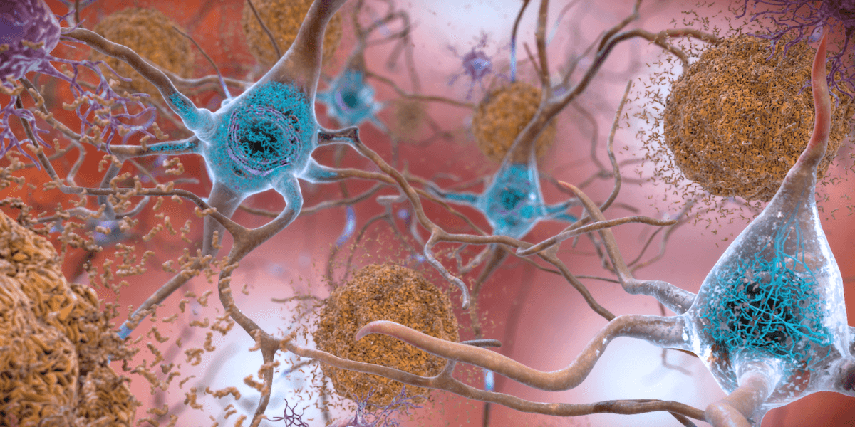 Onormala nivåer av beta-amyloidproteinet bildar plack, de bruna klumparna på bilden, som stör cellfunktionen i en hjärna som drabbats av Alzheimers
