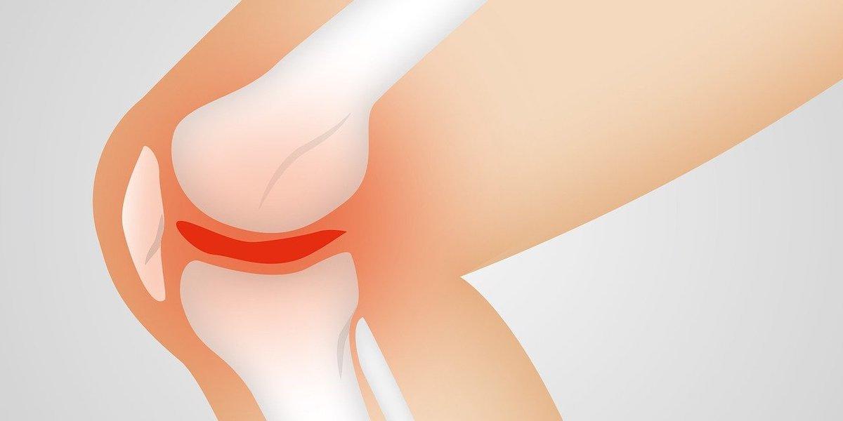 Illustration av ett knä med artros. Artros är svårt att diagnosticera och när det upptäcks är leden redan skadad, nu har forskare kanske hittat ett nytt sätt att ställa diagnos