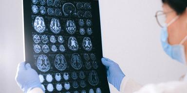 En läkare tittar på bilden av hjärnan. Tydliga tecken på tidig Alzheimers sjukdom försvann från en patients hjärna när han gjorde livsstilsförändringar