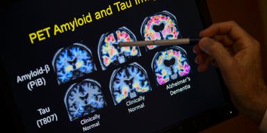 Bilder av friska och Alzheimersjuka hjärnor. Forskare har funnit två tydliga faser under Alzheimer sjukdom och i den första skadas hjärnan innan symtom uppstår och de kännetecknande proteinansamlingarna syns