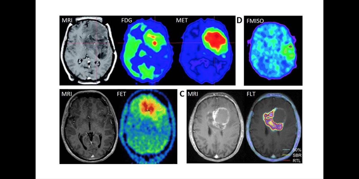 PET- och magnetkamerabilder av olika hjärntumörer