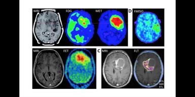PET- och magnetkamerabilder av olika hjärntumörer