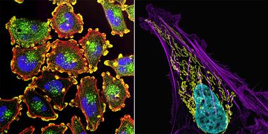 Olika cancerceller, till vänster, metastaserande melanomceller, alltså tumörbildande hudcancerceller. Till höger osteosarkom, eller bencancercell. Bilderna är från National Cancer Institute