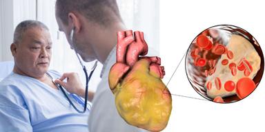 Forskare har funnit att ohälsosam och fiberfattig kost har ett samband med instabila plack i hjärtats kranskärl. en läkare lyssnar på en patients hjärta och en illustration av fetthjärta och fettplack i ett kranskärl.