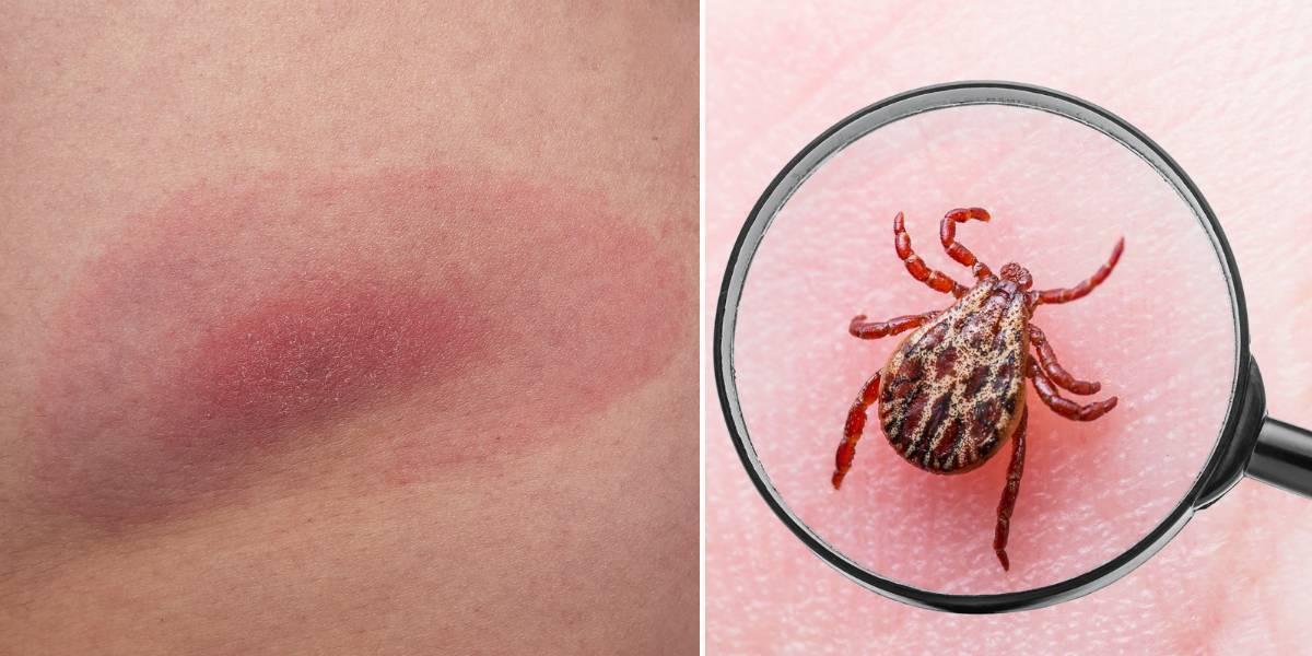 Borrelia har gett en röd ring på hunden och en fästing på huden.