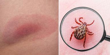 Borrelia har gett en röd ring på hunden och en fästing på huden.