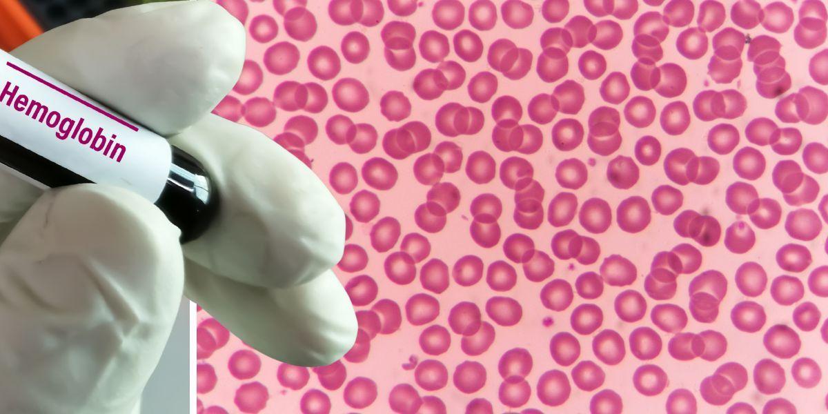 Ett provrör med texten hemoglobin och röda blodkroppar under ett mikroskop. I en ny studie har hemoglobin visat sig kunna bli en ny hjälp i kampen mot neurogenerativa sjukdomar som ALS, Alzheimers sjukdom och Parkinsons sjukdom. Hemoglobin finns i röda blodkroppar, men studien visar att det även finns i hjärnan.
