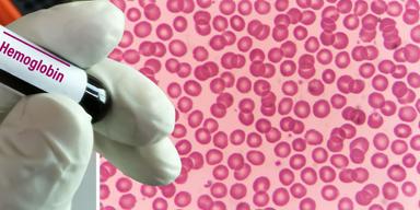 Ett provrör med texten hemoglobin och röda blodkroppar under ett mikroskop. I en ny studie har hemoglobin visat sig kunna bli en ny hjälp i kampen mot neurogenerativa sjukdomar som ALS, Alzheimers sjukdom och Parkinsons sjukdom. Hemoglobin finns i röda blodkroppar, men studien visar att det även finns i hjärnan.