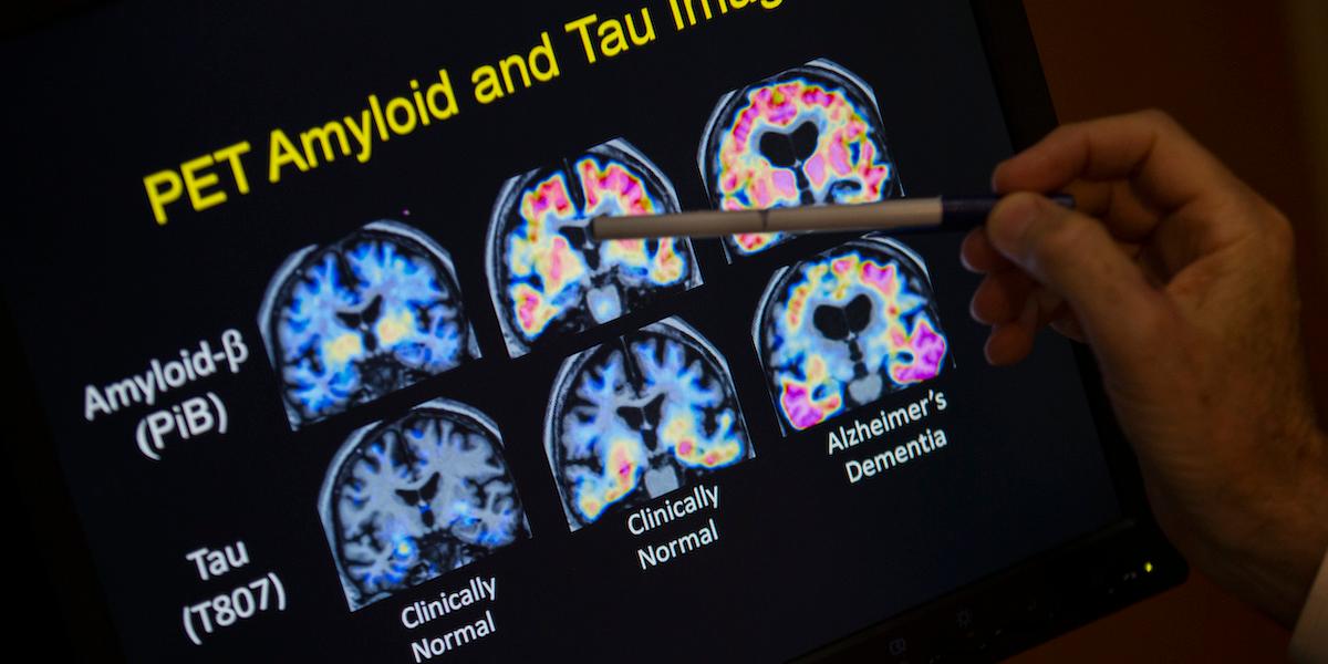 Bilder av hjärnor. En ny rapport visar att Alzheimers och andra av hjärnans sjukdomar kan förebyggas