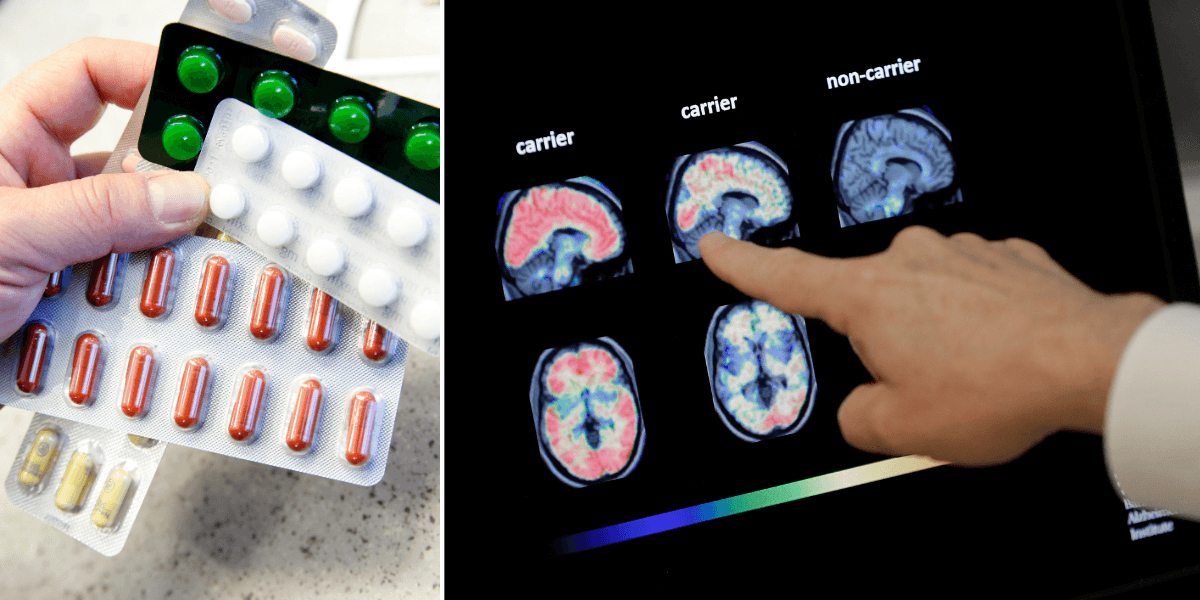 Pillerkartor till vänster och en hjärnscan av hjärnor med och utan alzheimer till höger.